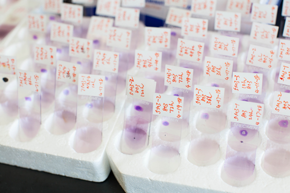 Blood stage malaria slides are used to count how many parasites are contained in each blood smear inside the lab at USF. 